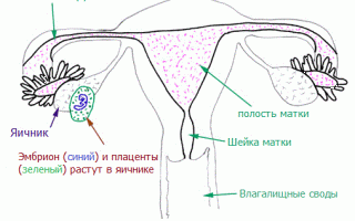 Внематочная беременность: симптомы, причины и лечение