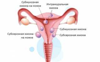 Боровая матка при лечении миомы: эффективность средства, отзывы врачей и пациенток