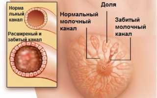 Что делать при появлении у кормящей мамы уплотнений в груди: причины, симптомы и последствия лактостаза