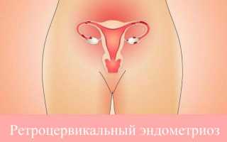 Симптомы и лечение ретроцервикального эндометриоза