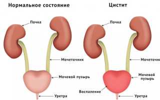 Особенности лечения цистита при грудном вскармливании