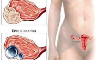 Киста и рак: симптомы, диагностика, виды и методы лечения