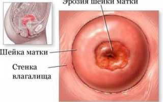Причины появления (железистой) псевдоэрозии шейки матки