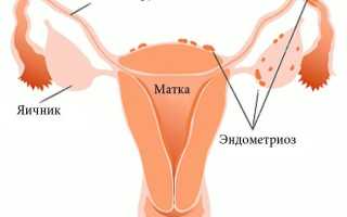 Послеродовой эндометрит. Причины, симптомы, лечение и профилактика