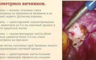 31 способ помочь себе облегчить боль при эндометриозе
