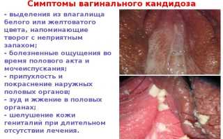 Особенности лечения молочницы Нистатином у женщин, мужчин и детей