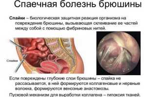 Все о методах лечения спаечного процесса в маточных трубах