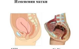 Субинволюция матки: симптомы, лечение, профилактика