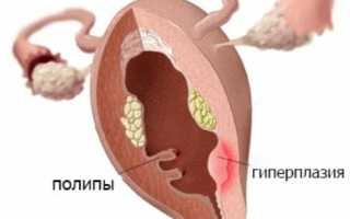 Когда приходят месячные после выскабливания эндометрия