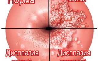 Можно ли вылечить эрозию шейки матки без прижигания: обзор методов и отзывы женщин
