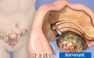 Фиброма яичника: симптомы, диагностика и принципы лечения