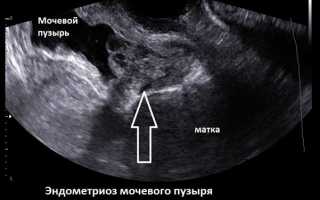 Причины и стадии развития эндометриоза мочевого пузыря, симптомы, лечение