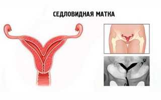 Однорогая матка: причины развития, диагностика, лечение