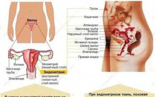 Почему при эндометриозе наблюдаются регулярные задержки месячных