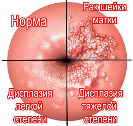 Биопсия шейки матки. Как делают, на какой день цикла, что нельзя после процедуры, расшифровка