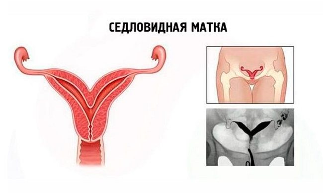 Двурогая седловидная матка