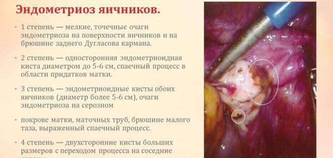 Эндометриоз яичников