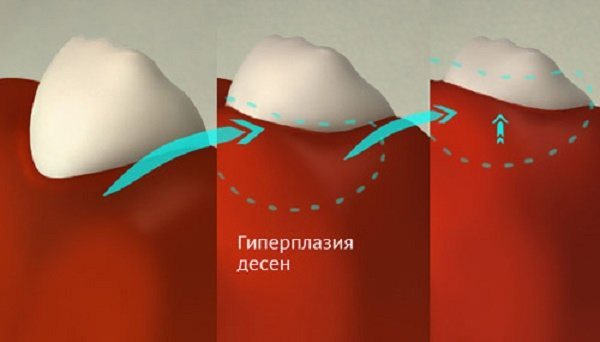 как возникает фиброматоз десен