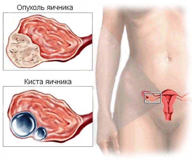 Опухоль и киста
