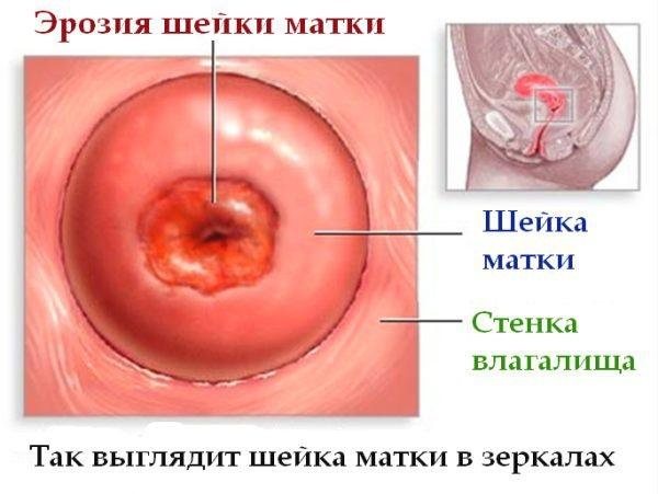 Противовоспалительные свечи в гинекологии для восстановления микрофлоры, при эндометриозе, с календулой, метилурациловые, ихтиоловые. Инструкции по применению