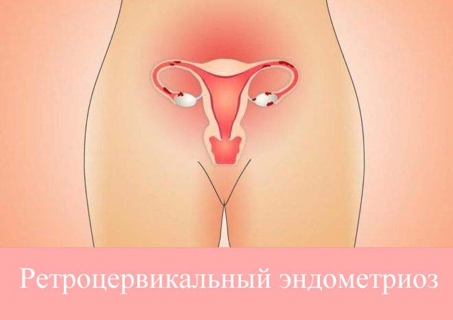 Ретроцервикальный эндометриоз