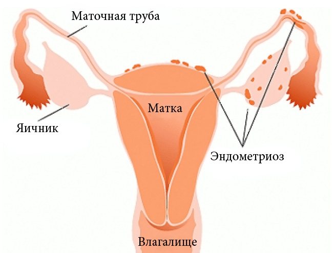виды эндометриоза