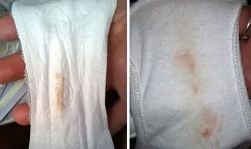 Выделения при имплантации плодного яйца