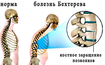 Болезнь Бехтерева