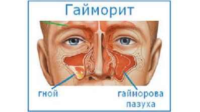Когда болит спина и температура воды