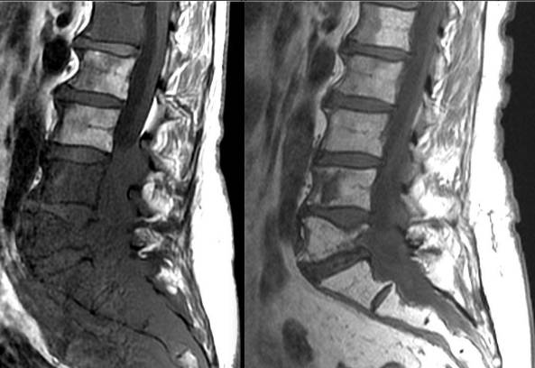 Твердая шишка на спине болит
