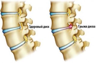 Почему болит спина справа при вдохе