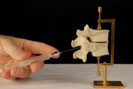 болит спина после эпидуральной анестезии