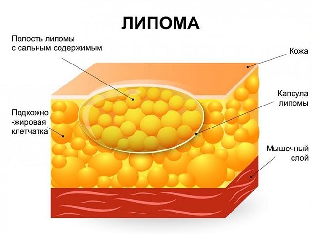 Твердая шишка на спине болит