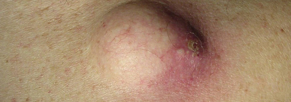 Твердая шишка на спине болит