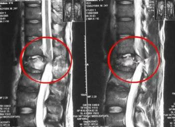 При наклонах вперед болит спина в лопатках