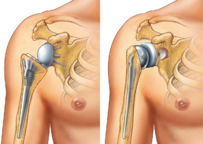 Эндопротезирование плечевого (1)