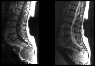 Твердая шишка на спине болит