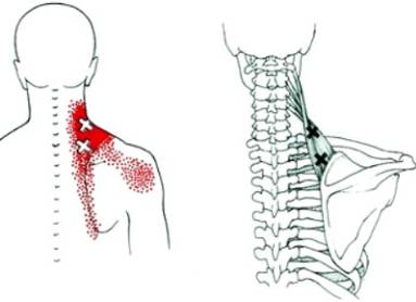 Болит спина чуть ниже лопаток посередине