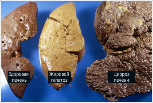 Заболевания печени