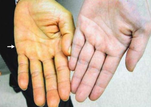 Желтушность кожи