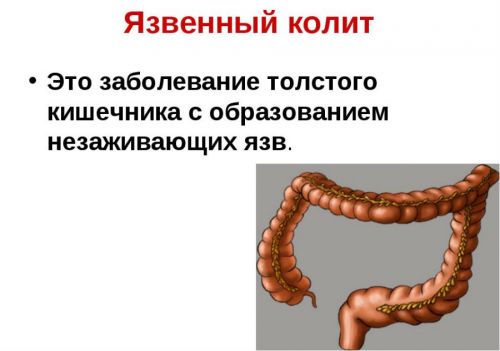 Язвенный колит