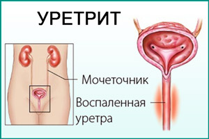 Уретрит Воспаление уретры