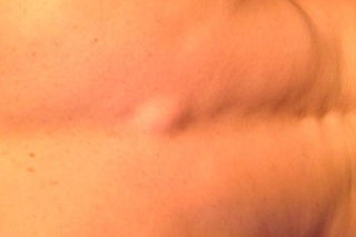 Твердая шишка на спине болит