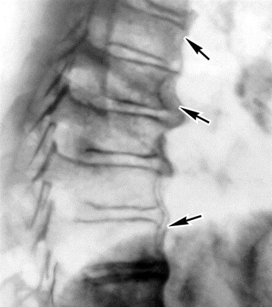 Болит позвоночник в центре спины