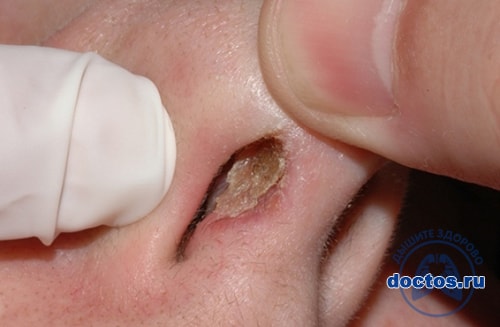 Желтые корки в носу