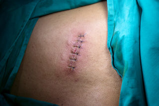 Твердая шишка на спине болит