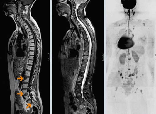 метастазы в печени болит спина