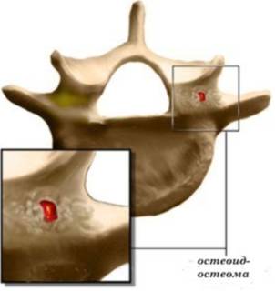 Твердая шишка на спине болит