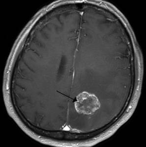 Сильно болит голова если слабость