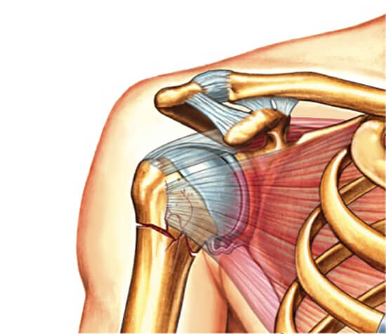 perelom-shejki-plecha (3)